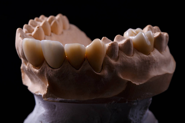 Forma zębów. Tynk gipsowy z zębami. Tynk odlewany z ludzkich zębów w ramach przygotowań do produkcji korony dentystycznej. Koncepcja stomatologii i ortodoncji. - Zdjęcie, obraz