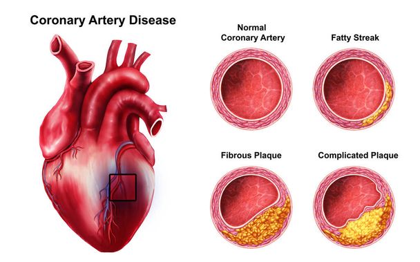  Illustrazione medica della malattia coronarica - Foto, immagini