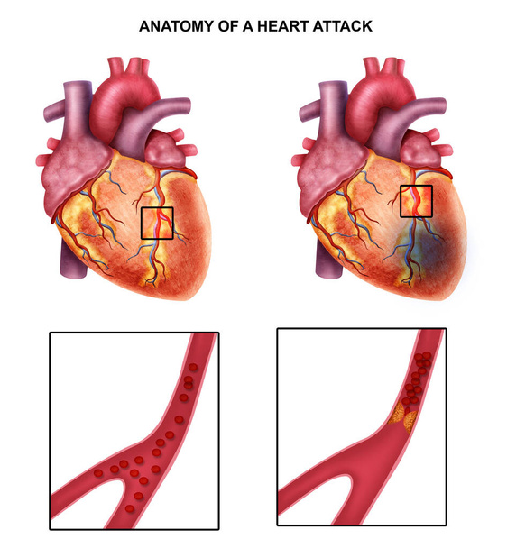  Ιατρική απεικόνιση της καρδιακής προσβολής - Φωτογραφία, εικόνα