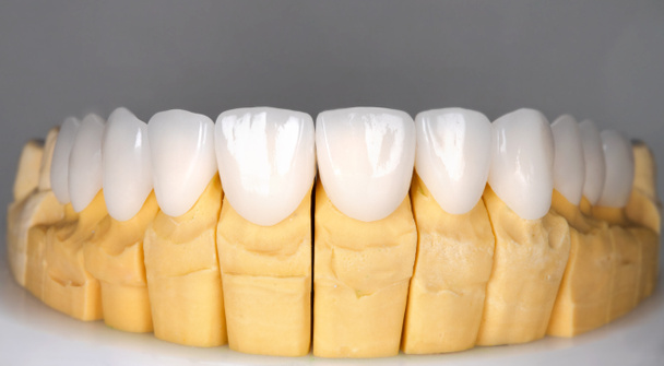 美しい上歯セラミックプレスのベニヤは、ジルコンアーチのプロテーゼの漂白インプラントクラウン。歯科修復治療クリニック患者。口腔外科手術の結果｜ホワイトニング歯科 - 写真・画像
