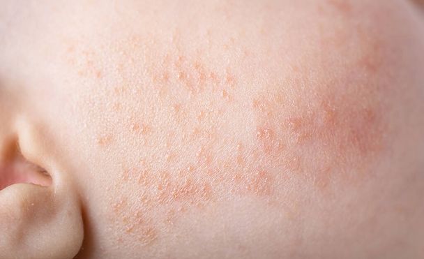 close-up van baby-atopische dermatitis allergie uitslag op de wangen - Foto, afbeelding
