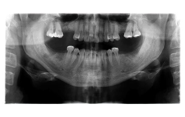 Панорамний стоматологічний рентгенівський промінь з зубами
 - Вектор, зображення
