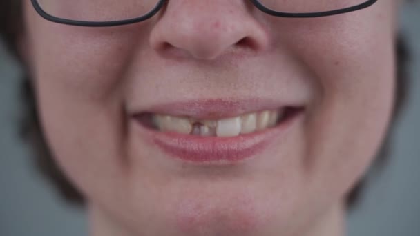Mujer joven y sonriente caucásica con un diente delantero roto del que sobresalen alfileres de fibra de vidrio. Lesión dental, fractura del diente mitad después del accidente. Odontología y tratamiento maxilofacial. Trauma dental - Imágenes, Vídeo
