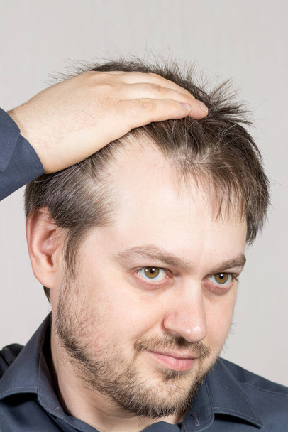 男は頭髪を後退させて高い額を示しています。男性の脱毛、ヘアケア - 写真・画像