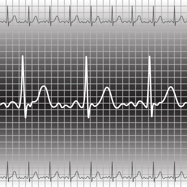 Elektrocardiogram - Vector, afbeelding