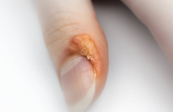 Close up Wart on finger. Contagious skin illness on woman's hand. Medical treatment, macro photo. - Photo, Image