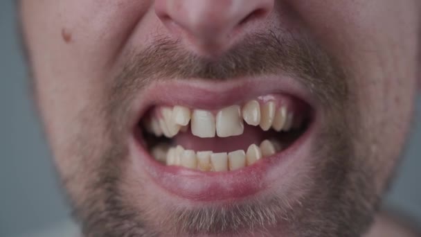 Desplazamiento dental. Boca masculina con dientes torcidos y maloclusión. Multitud de dientes de la mandíbula superior. Ortodoncia. Dientes superpoblados, oclusión dental anormal. Dientes antes de instalar aparatos ortopédicos - Metraje, vídeo