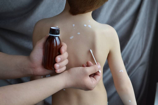Infectious diseases, chickenpox. Dad administering antipruritic white lotion to the virus for smallpox symptoms on the child's . - Photo, Image
