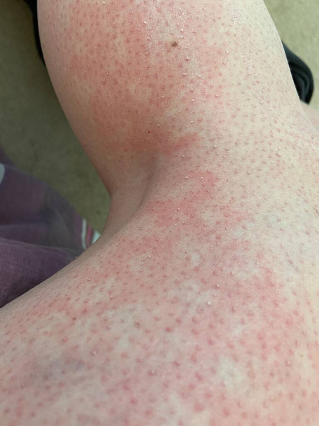 heat rash hives allergy reaction on knee close-up reference picture of blotchy mottled red skin erythema ab igne also known as EAI - Photo, Image