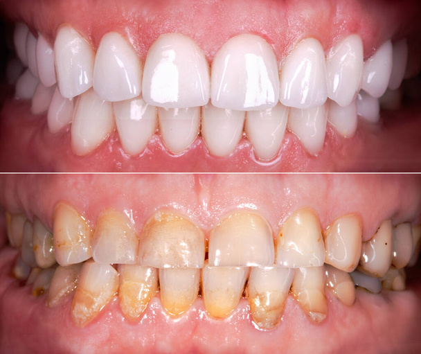 Zirkon kemeri seramik protezinin kaplamaları beyazlatılmadan önce ve sonra mükemmel bir gülümseme. Diş tedavisi kliniği hastası. Yetişkin yaşlı kadın cerrahi prosedürü diş beyazlatma - Fotoğraf, Görsel