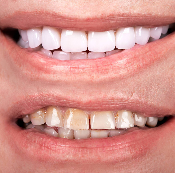 初心者の前と後の完璧な笑顔ジルコンアーチセラミックプロテーゼの漂白インプラントクラウン。歯科修復治療クリニック患者。成人女性の手術手順美白歯科 - 写真・画像