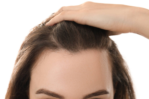 Woman suffering from baldness on white background, closeup - Foto, afbeelding
