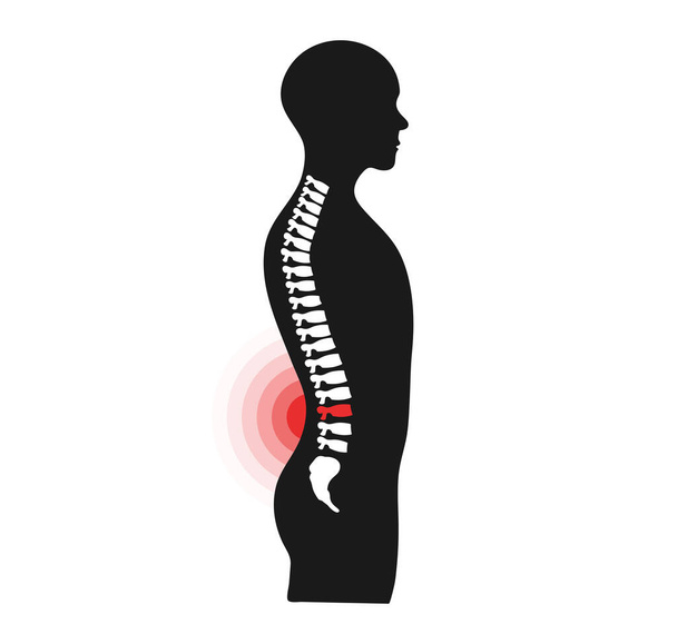 Rückenschmerzen. Gesundheitsproblem der menschlichen Wirbelsäule. Schmerzkreis. Illustration Medizin und Gesundheitswesen. - Vektor, Bild