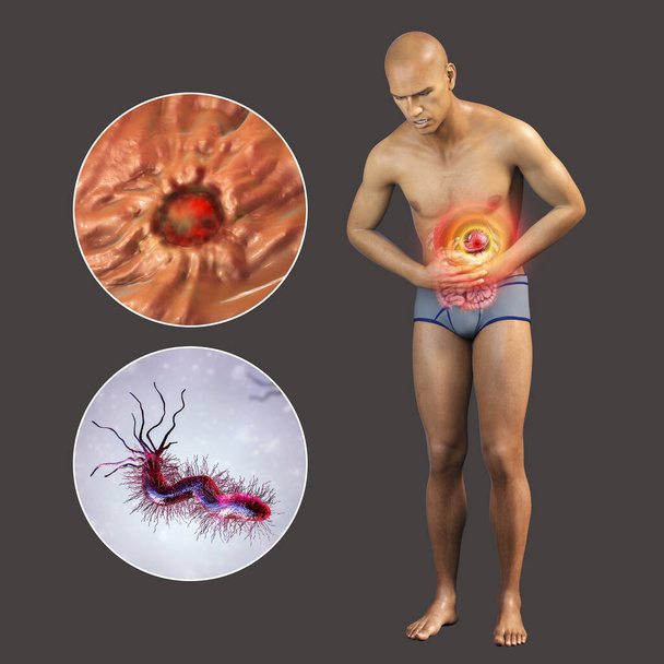 胃の痛み,胃潰瘍,概念的な3Dイラスト.胃を強調し、消化性潰瘍と細菌のクローズアップビューを持つ患者潰瘍の開発を引き起こすヘリコバクターピロリ菌 - 写真・画像