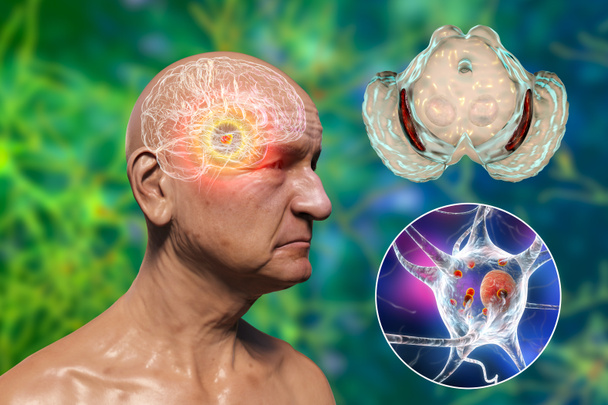 Старик с болезнью Паркинсона и выделил черную субстанцию среднего мозга. 3D иллюстрация показывает уменьшение объема субстанции и накопление тел Леви в дофаминергических нейронах - Фото, изображение