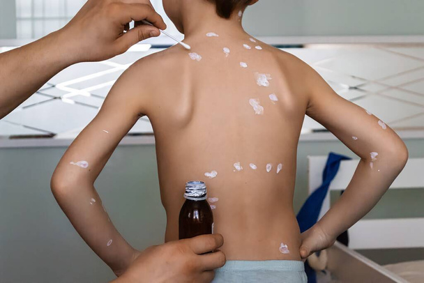 Il concetto di trattamento dei sintomi della varicella con lozione bianca anti-prurito, cura dei genitori. - Foto, immagini