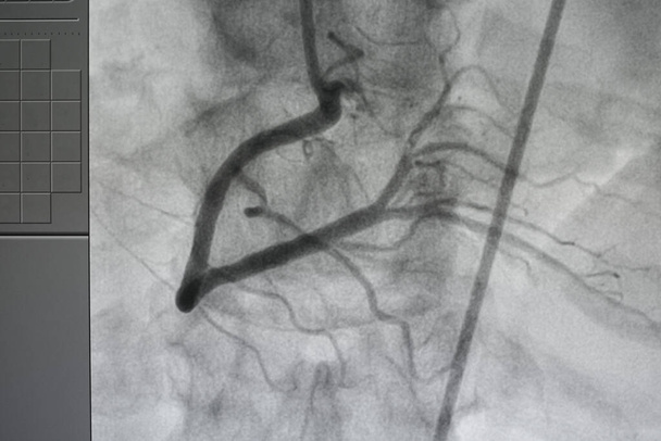 Angiografía coronaria, coronariografía izquierda y derecha - Foto, imagen