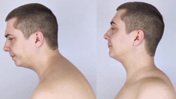 Kyphosis előtt és után. A férfinak gerinc görbülete van a felső részén. A nyaki csigolyák kidudorodnak és púpot formálnak. Görbe és helytelen testtartás kezelési koncepció - Felvétel, videó