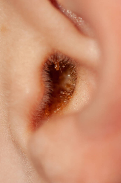 Photo of an ear full of earwax. Close-up ear. Personal hygiene. Depth of field - Photo, Image