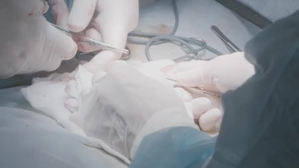 Os médicos realizam a operação para remover o apêndice. Acção. Cirurgiões operam em pessoa sob anestesia. Remoção do tumor e cirurgia de órgãos - Filmagem, Vídeo