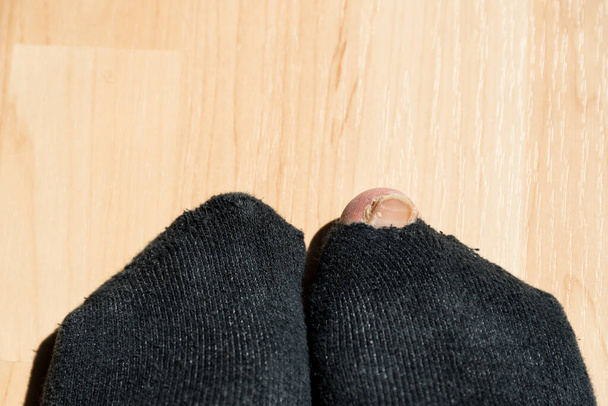 Toe looks through sock with hole - close-up - Foto, imagen