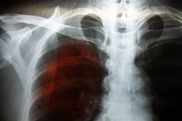 Röntgen der Brust des Patienten covid-19 medizinisches Wissenschaftskonzept. - Foto, Bild