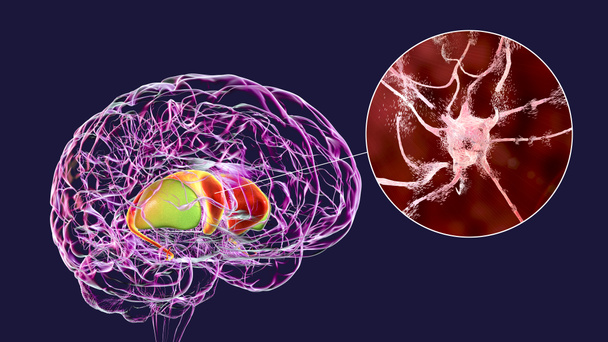Estrato dorsal destacado no cérebro humano e visão de perto de neurônios degradantes do estriado dorsal vistos na doença de Huntington, ilustração 3D - Foto, Imagem