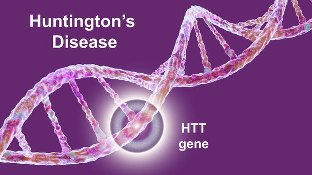 Huntington hastalığı, Huntington koreası olarak da bilinir, bir nörodejeneratif hastalık, avlanma geni olan HTT 'deki mutasyondan kaynaklanır, kavramsal 3D çizim. - Fotoğraf, Görsel