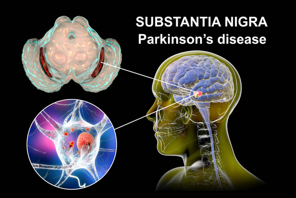 Черное вещество среднего мозга при болезни Паркинсона, 3D иллюстрация, показывающая уменьшение его объема и накопление тел Леви в дофаминергических нейронах черного вещества - Фото, изображение