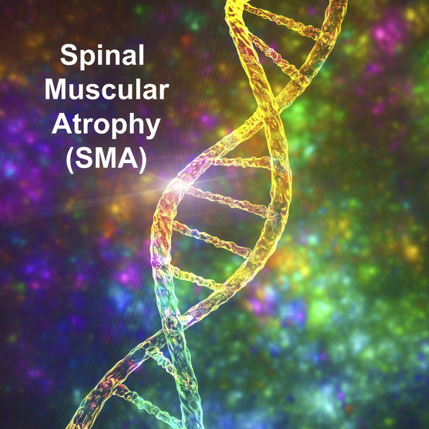 Spinal kas atrofisi, SMA, SMN1 genindeki mutasyon nedeniyle motor nöron kaybı nedeniyle ilerleyen kas atıkları ile genetik nöromusküler bozukluk, kavramsal 3D çizim - Fotoğraf, Görsel