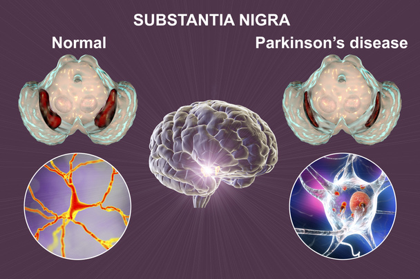正常な状態とパーキンソン病の中脳とそのドーパミン作動性ニューロンの黒い物質。神経細胞におけるルイス体の体積減少と蓄積を示す3次元図 - 写真・画像