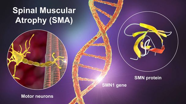 Atrofia muscular espinal, SMA, un trastorno neuromuscular genético con desgaste muscular progresivo debido a la pérdida de neuronas motoras debido a la mutación en el gen SMN1, ilustración conceptual 3D - Foto, Imagen