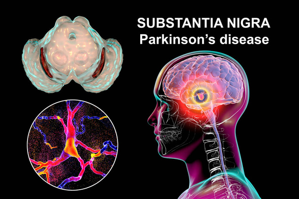 Black substance of the midbrain in Parkinson's disease, 3D illustration showing decrease of its volume and degeneration of dopaminergic neurons in the pars compacta of the Black substance - Photo, Image