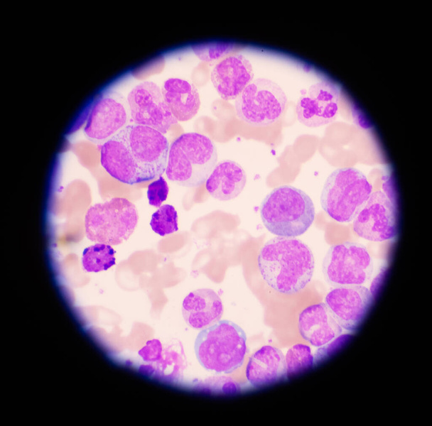 Gemengde fase witte bloedcel op rode bloedcellen achtergrond.Leukemie concept. - Foto, afbeelding