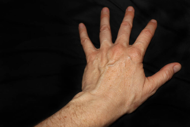 Grote, gezwollen aderen aan de linkerhand van een volwassen vrouw tegen een zwarte achtergrond. - Foto, afbeelding