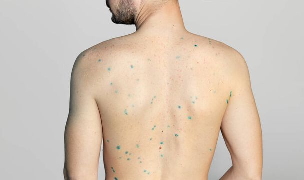 Body of adult  man have spotted, red pimple and bubble rash from chickenpox or varicella zoster virus. Medical complications after illness. Treatment with brilliant green - Foto, afbeelding