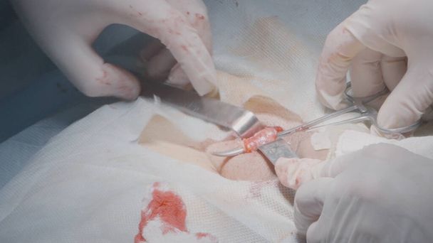 Chirurgen verwijderen orgaan uit het lichaam. Actie. Chirurgen openen incisie om bij het orgaan te komen. Interne orgaanchirurgie of appendicitis verwijdering - Foto, afbeelding