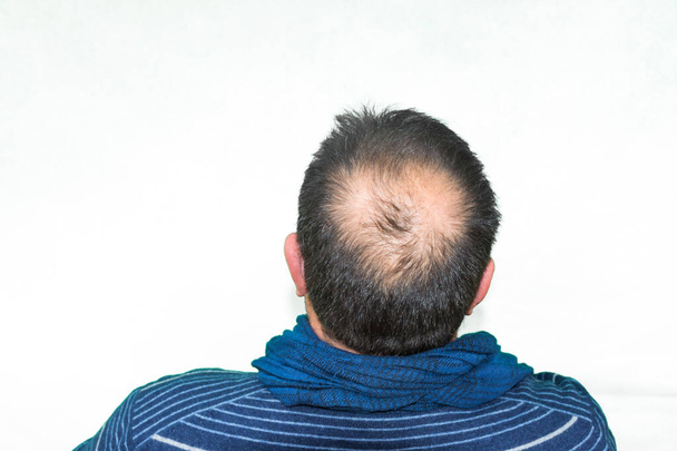 トライコロジストの美容師のオフィスではげスポットを持つ若い男。男の頭の上にはげ。男性型脱毛症。男性の脱毛と戦う - 写真・画像