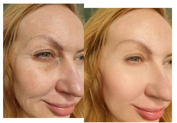 woman eyes wrinkles before and after treatment - Photo, Image