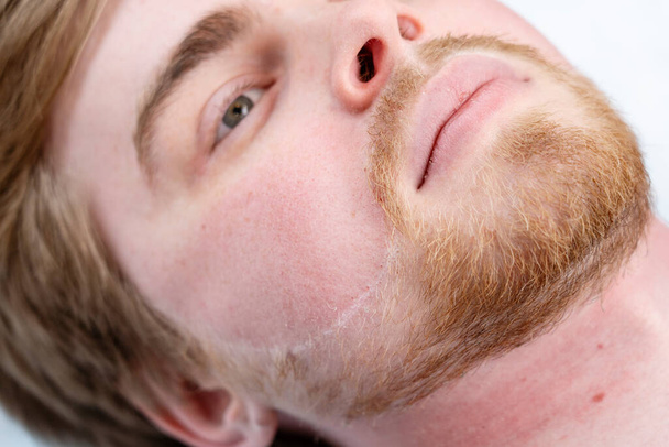 Male depilation hair removal beard and mustache procedure treatment in salon. Skin after procedure. - Photo, Image