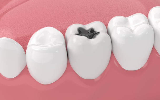 Rozpad zębów, niezdrowe zęby, renderowanie 3D. Cyfrowy rysunek komputera. - Zdjęcie, obraz