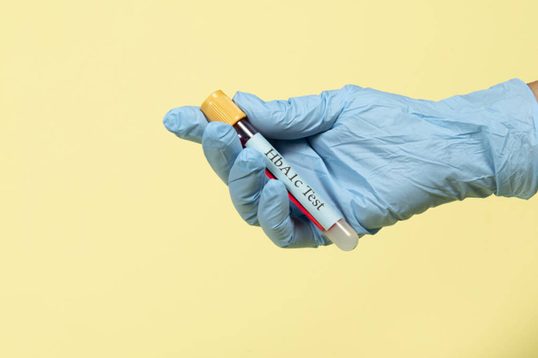 Blood sample in a vacuum tube for hemoglobin HbA1c test  diabetes diagnosis - Photo, Image