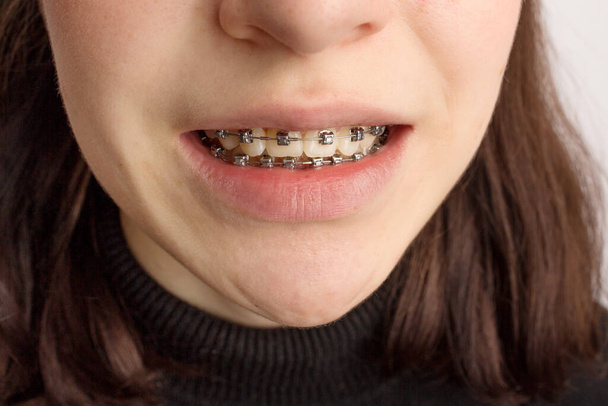 Tratamiento ortodóncico. Concepto de cuidado dental. Adolescente sonriente con frenillos. Abrazaderas de metal de cerca en los dientes. - Foto, Imagen