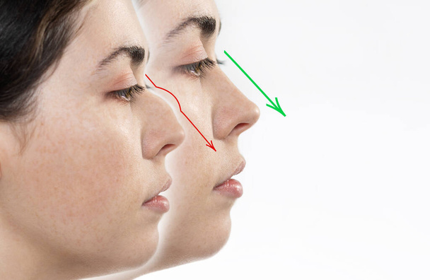Neuscorrectie. Twee vrouwelijke gezichten close-up tonen het resultaat voor en na neuscorrectie. Zijaanzicht. Witte achtergrond. Kopieerruimte. - Foto, afbeelding