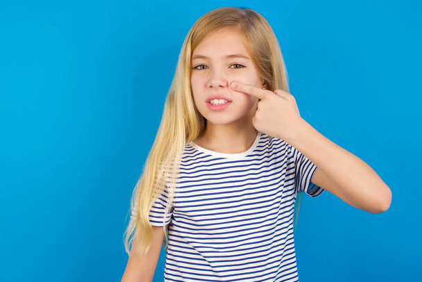 Chica caucásica con camisa a rayas contra la pared azul, señalando infeliz a la espinilla en la frente, fea infección de la cabeza negra. Problema de acné y piel - Foto, imagen