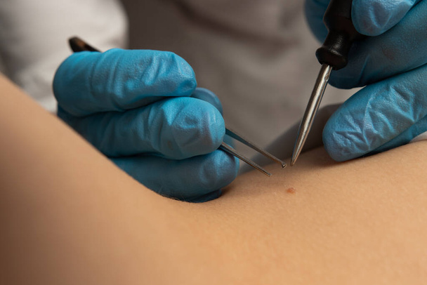 Removing a mole on the body close-up. Instruments, tweezers, medicine, procedure, beauty, skin - Fotó, kép