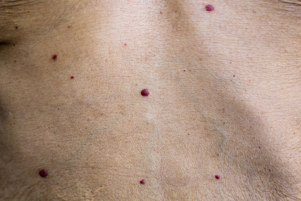 Czerwone pieprzyki, lub angiomas wiśni, są wspólne narośle skóry, które mogą rozwijać się na większości obszarów ciała. Są one również znane jako starcze naczyniaki. - Zdjęcie, obraz