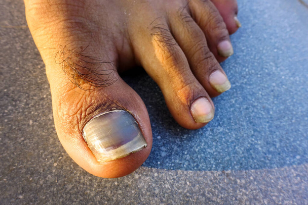 Zakrzep z bliska pod paznokciem od dużego palca u nogi z powodu urazu. Zna też palec biegacza lub palec tenisowy. - Zdjęcie, obraz