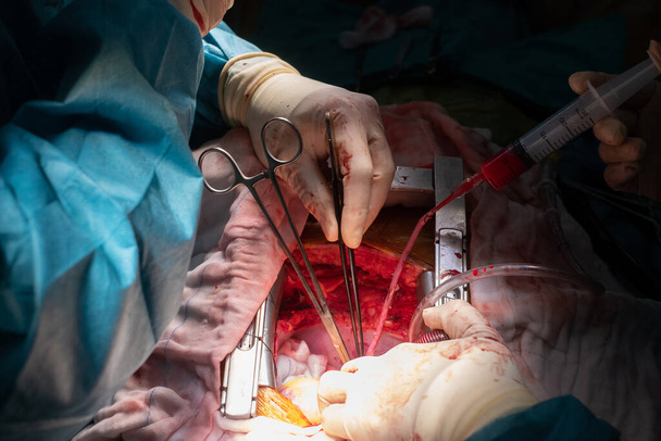 Koronararterien-Bypass-Transplantation (CABG). Chirurgie zur koronaren Bypass-Transplantation: CABG. Der Arzt und das Personal behandeln im vollen Operationssaal eine Herzbypass-Operation am offenen Herzen. - Foto, Bild