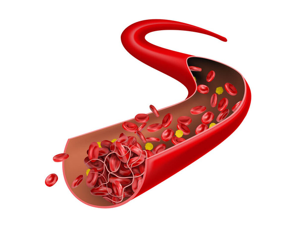 Veine avec cholestérol, qui arrête l'écoulement des érythrocytes rouges. Illustration vectorielle 3D - Vecteur, image